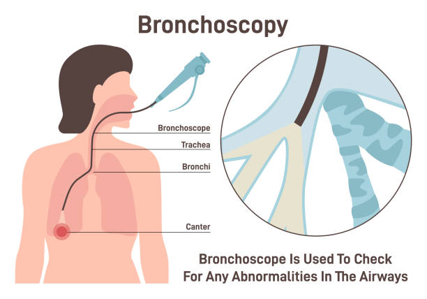 Bronchoscopy