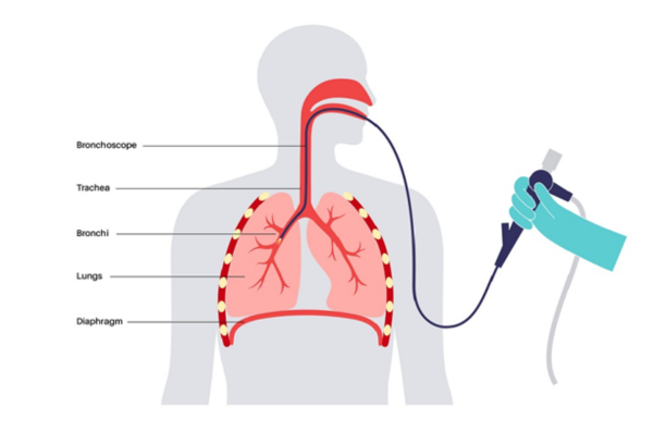 Bronchoscopy