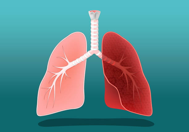 Interstitial Lung Disease (ILD)