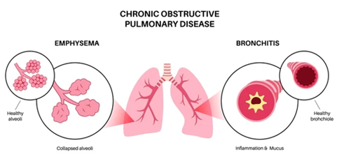 Causes and Risk Factors of COPD