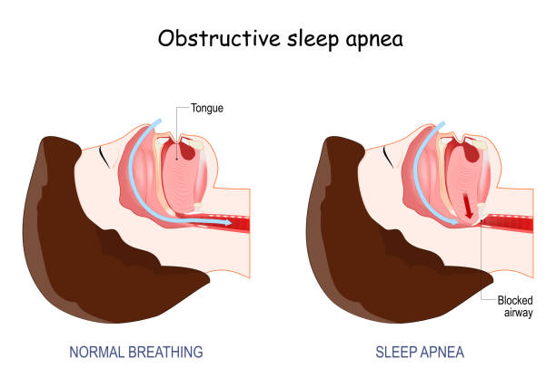 Picture2 What is Sleep Apnea?
