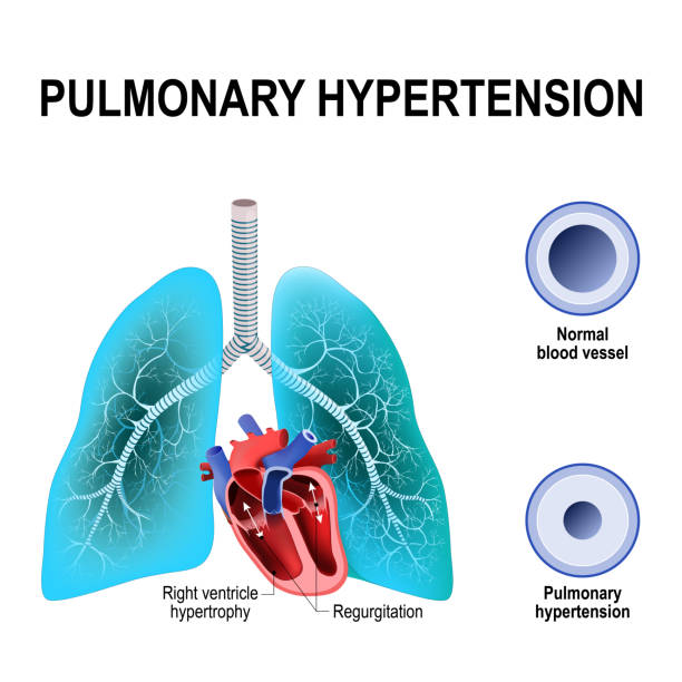 Pulmonary-Hypertension