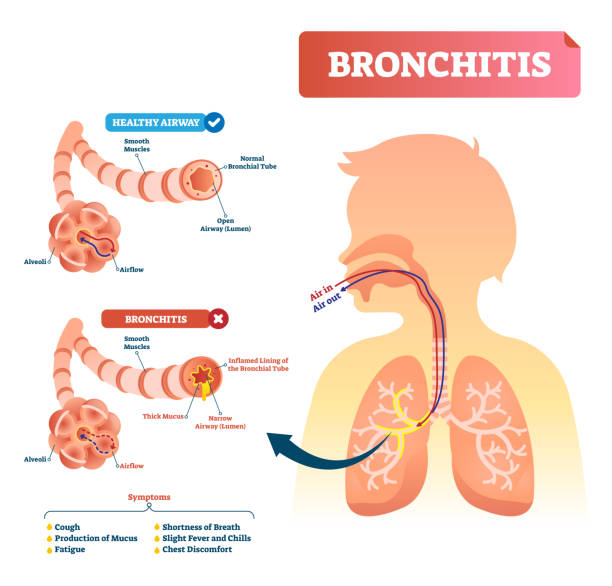 Bronchitis