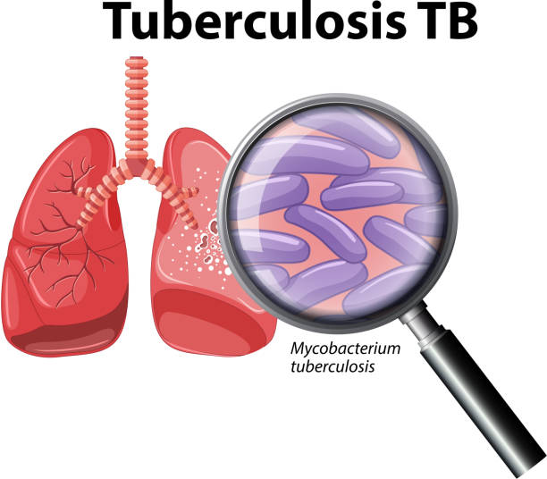 Tuberculosis
