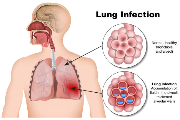 lung-infection