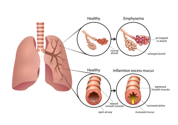 copd
