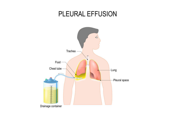 Pleural-Effusion