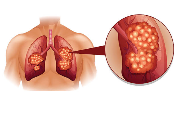 Lung Cancer