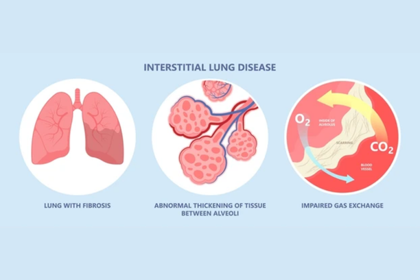 Interstitial Lung Diseases