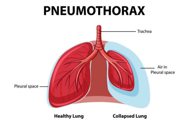Pneumothorax
