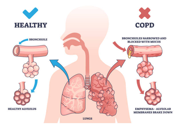copd-treatment-in-noida