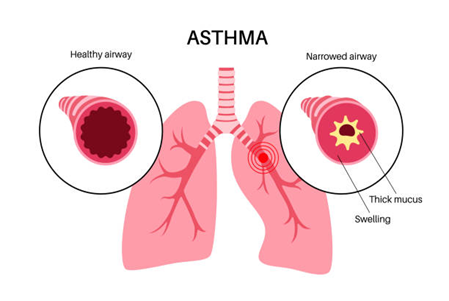 understanding-asthma-and-types