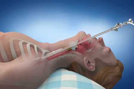 word_media_image3 - drmanumadan.com Rigid Bronchoscopy