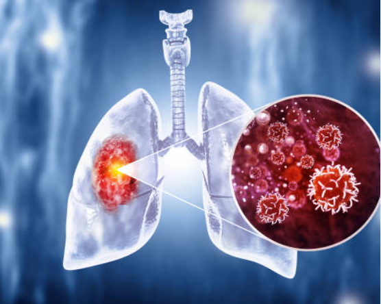 Medical illustration of lungs showing a highlighted left-lung tumor with a magnified inset of cancer cells