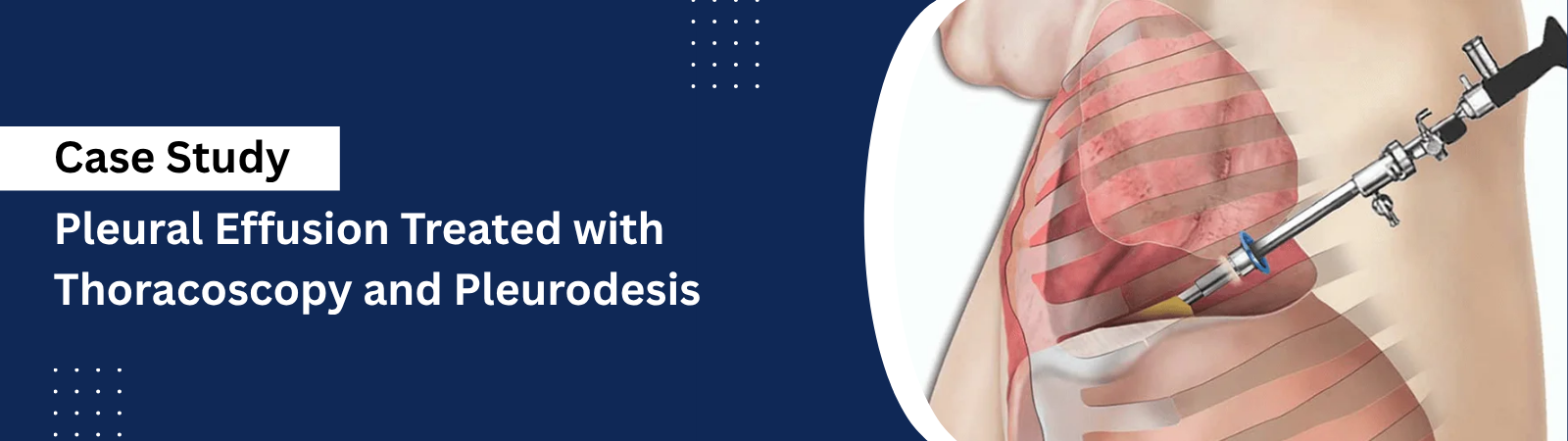 Pleural Effusion Treated with Thoracoscopy and Pleurodesis