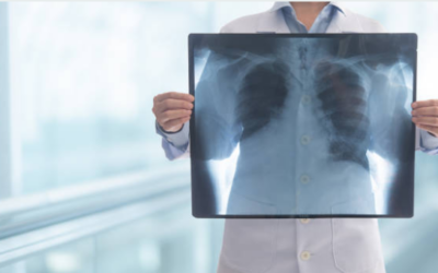 HRCT Chest vs CT Scan: Which Scan Is Best for Your Lungs?