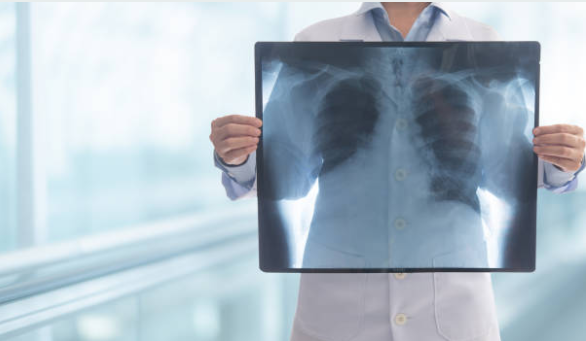 Medical professional holding a chest X-ray film showing the lungs viewed from the front.