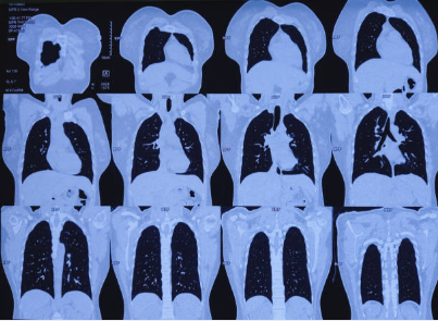 Series of blue-tinted chest CT slices showing lungs from top to bottom (cross-sectional images). Use for thoracic imaging review.
