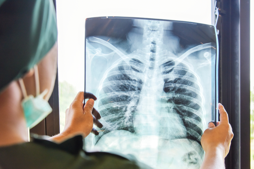 Medical professional wearing a mask holds a chest X-ray film up to a light source, outlining the lungs and heart in a hospital setting.