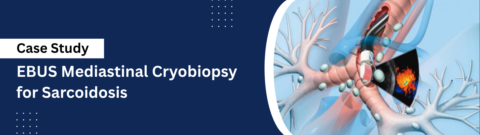 EBUS Mediastinal Cryobiopsy for Sarcoidosis - drmanumadan.com EBUS Mediastinal Cryobiopsy for Sarcoidosis