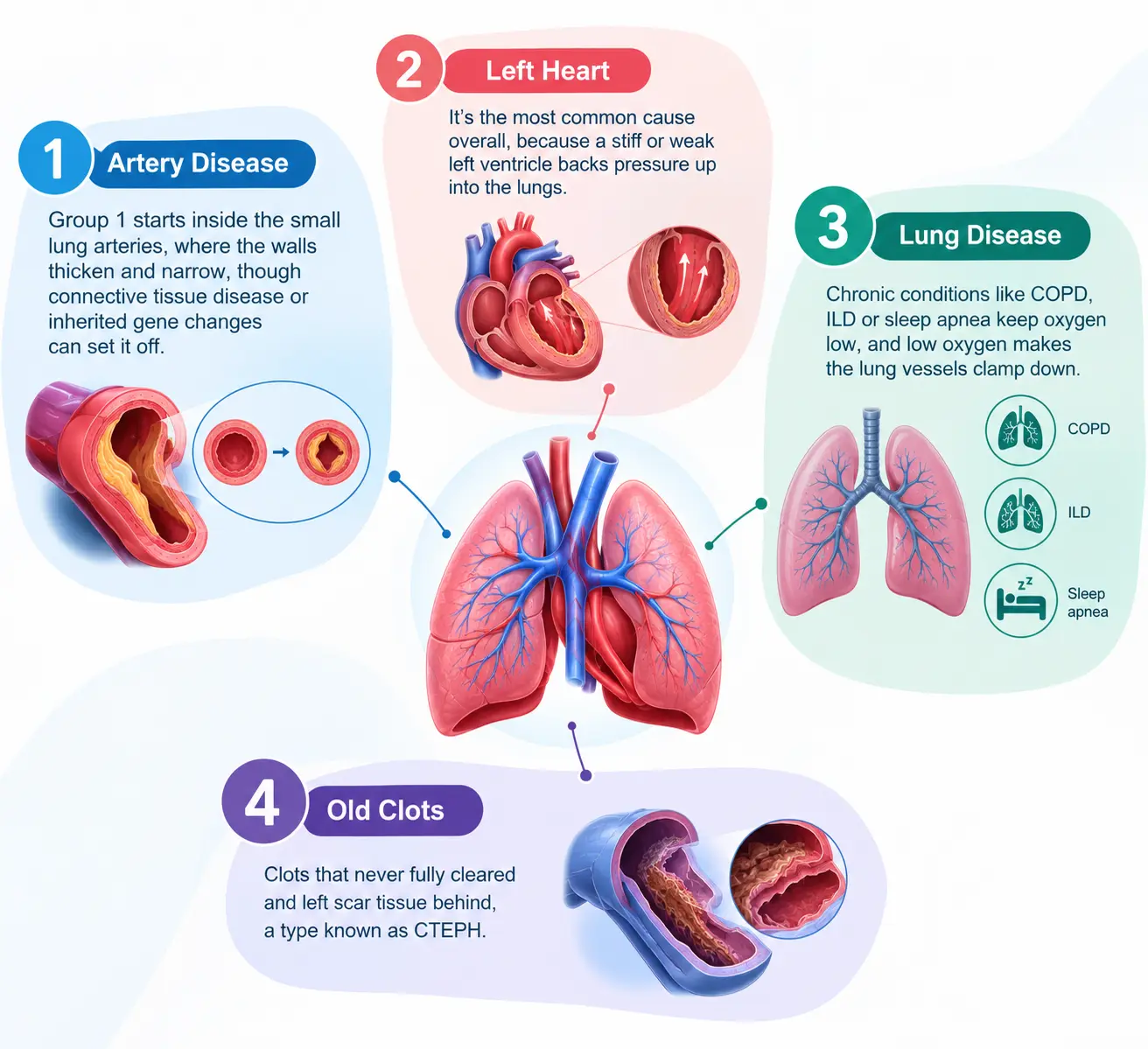 Five Causes of Pulmonary Hypertension - drmanumadan.com Five Causes of Pulmonary Hypertension