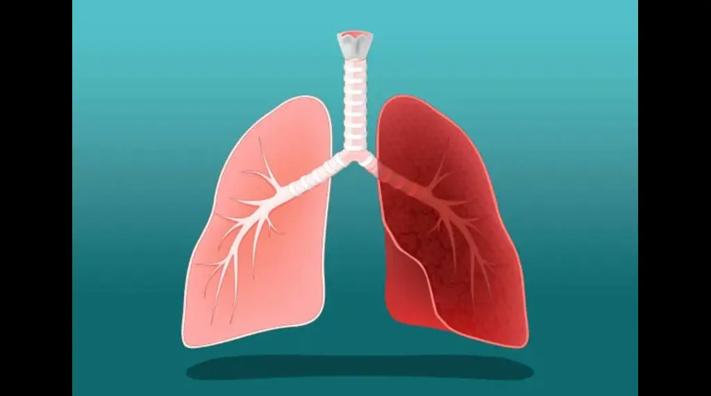 ILD 1 - drmanumadan.com Cartoon diagram of the human lungs with the trachea and branching airways, showing left and right lungs.